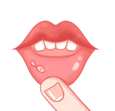 Oral Lesions-mouth ulcers