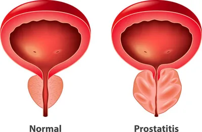 Benign Prostatic Hyperplasia