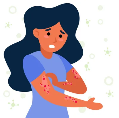 Eczema