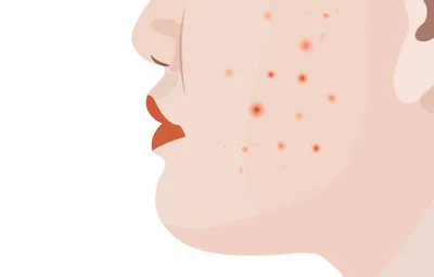 Blemish Prone Skin